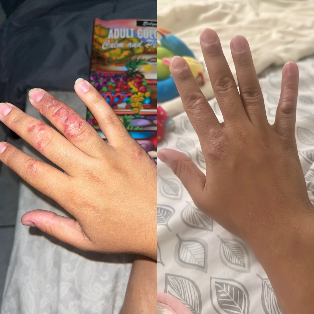 2 jabones transformaron mi piel y mi vida: Mi lucha contra la psoriasis